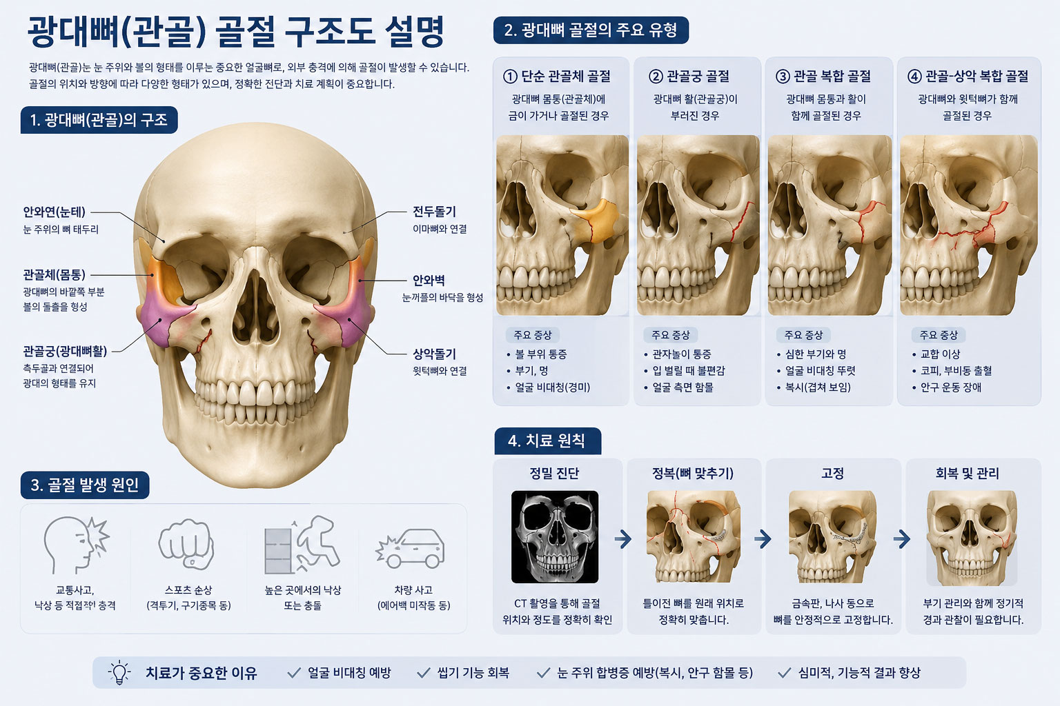 광대뼈 골절 구조도 — 광대뼈가 이마·위턱·관자뼈와 만나는 세 연결부가 함께 부러지는 삼각 골절(ZMC) 형태를 보여주는 그림