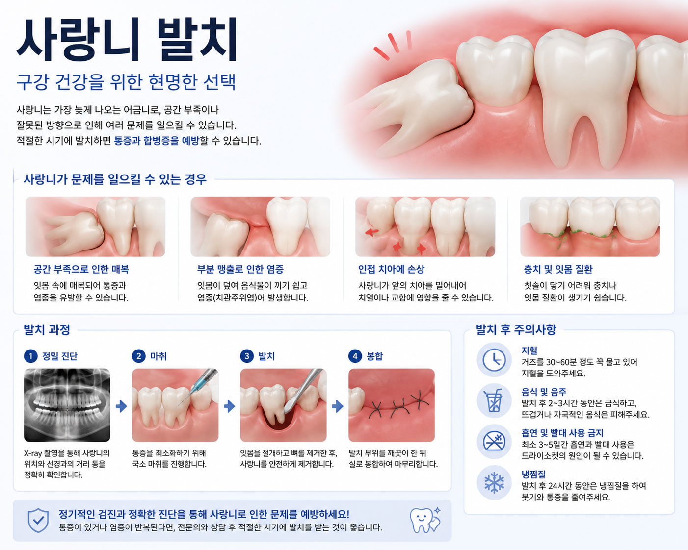 사랑니 발치 설명 이미지 — 매복 사랑니(제3대구치)의 위치와 주변 치아·구조를 보여주는 그림