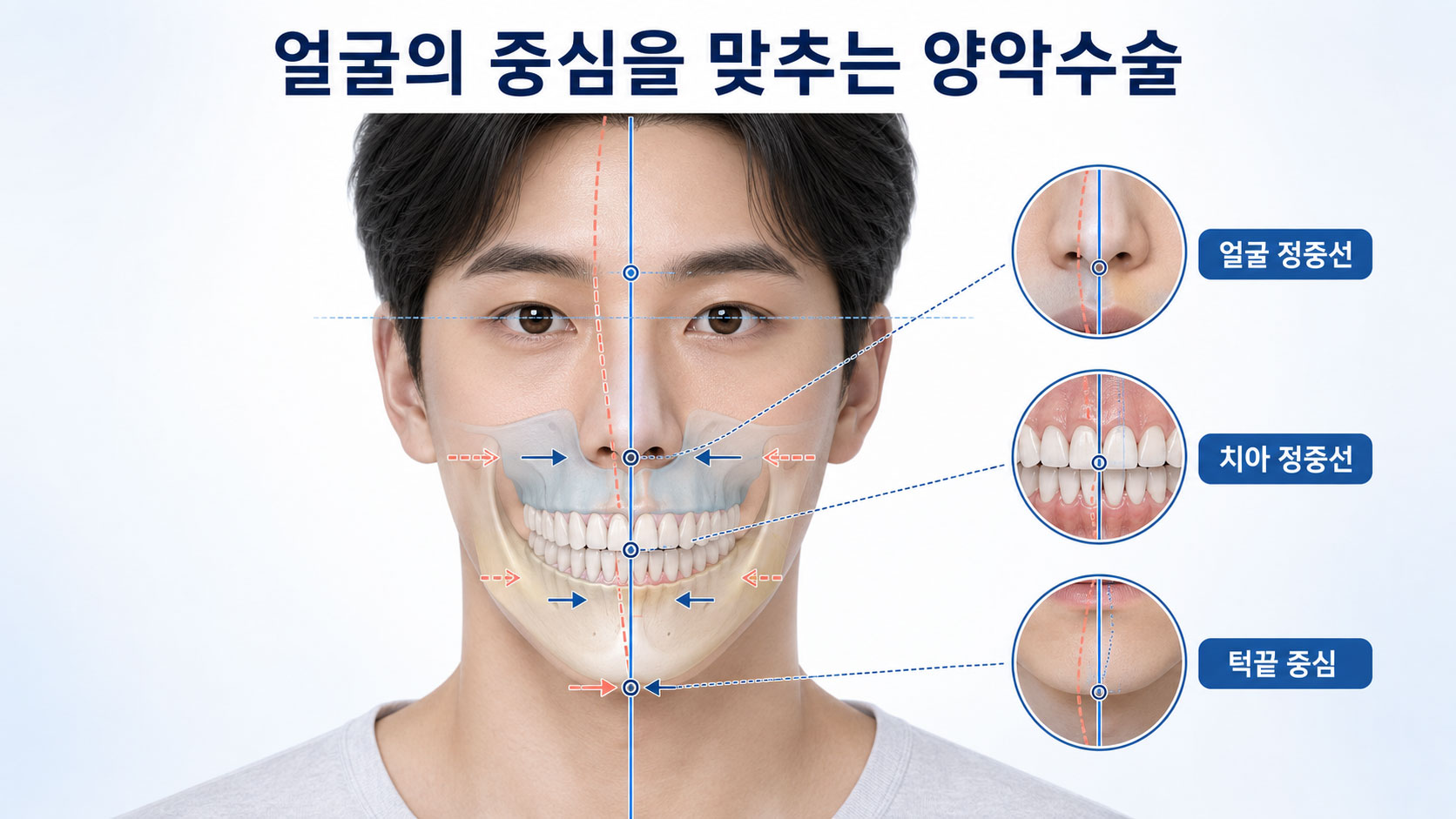 양악수술 얼굴 중심선 맞추기 설명 이미지 — 얼굴 정중선과 치아 중심선이 어긋난 상태를 위턱은 얼굴 중심선에, 아래턱은 가운데로 맞추는 원리를 보여주는 그림
